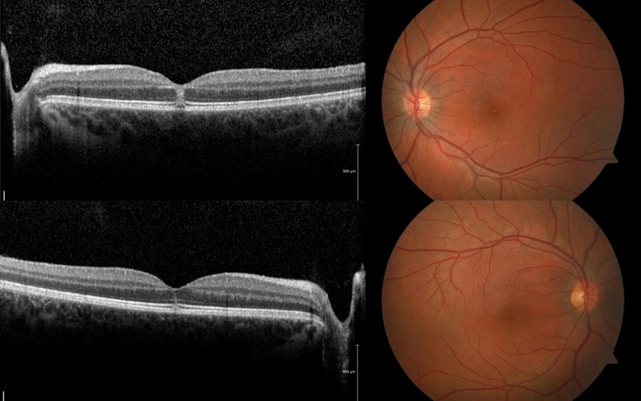retinopatia solar